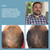 Hairmax - RegrowMD 272 Laser Hair Growth Cap