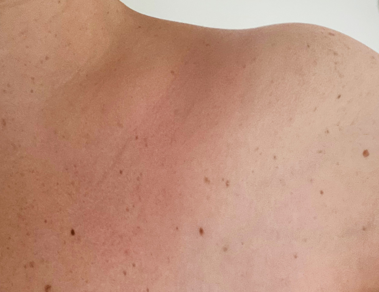 Sunburned skin is no longer red and burning after 1 application of Pevonia's After-Sun Soothing Gel