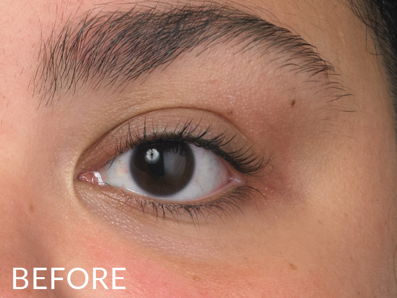 Dark circles under eyes before using Pevonia's EyeRenew Conceal & De-Age Tinted Under Eye Moisturizer