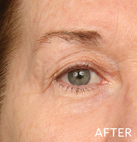 Lumafirm Eye Contour After One Use - Instant Results - Tightened and Brighter Skin Around Eye Contour