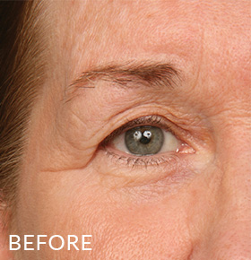 Lumafirm Eye Contour Before