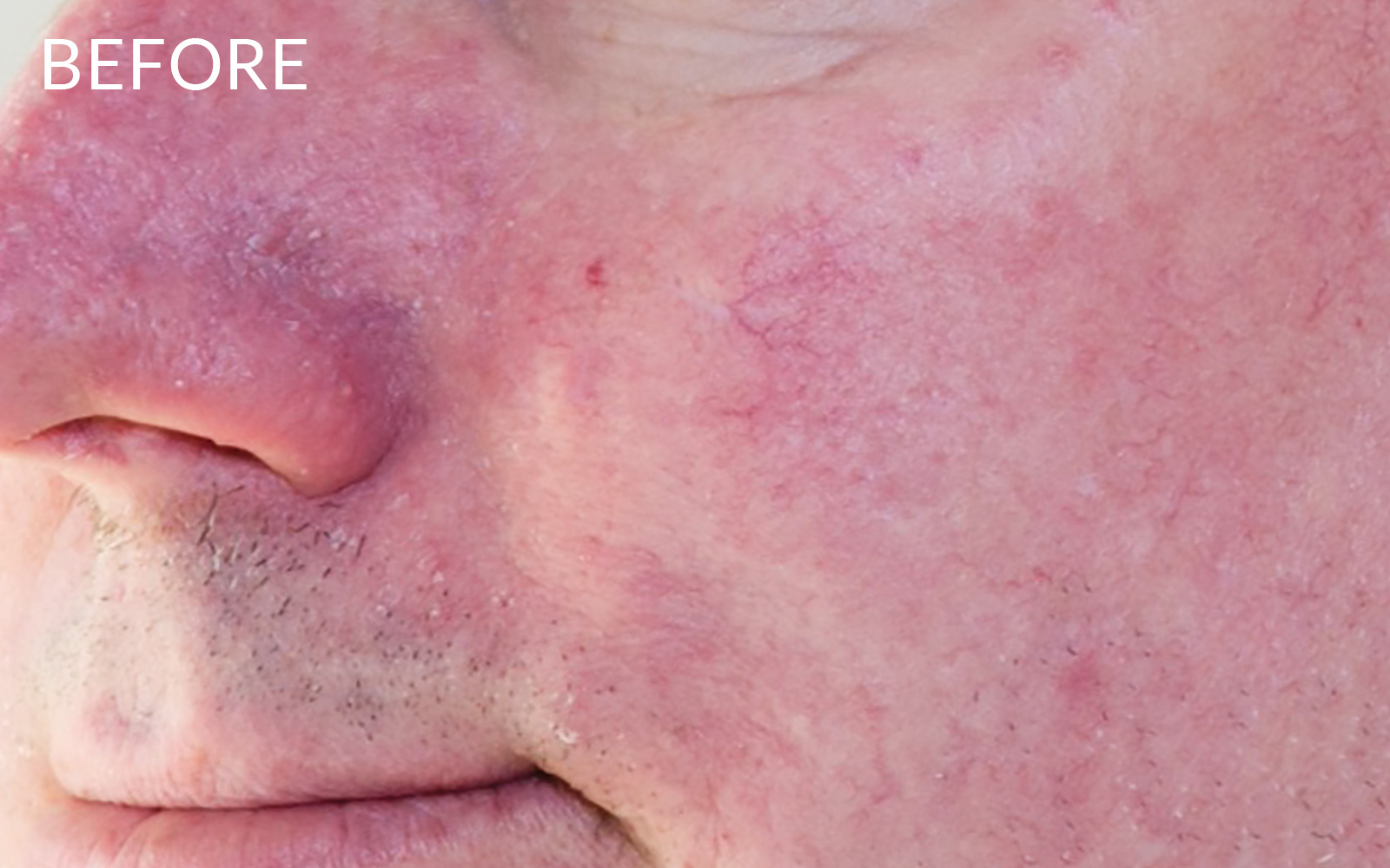 Close up photo of red irritated skin on cheek and nose with Rosacea before using Pevonia's RS2 Line