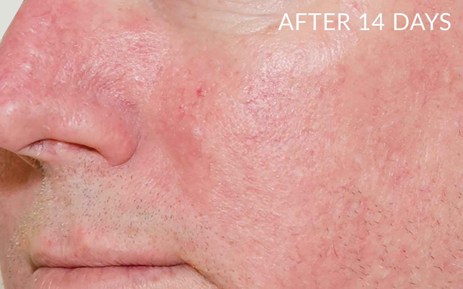 Close up photo of cheek and nose after using Pevonia's RS2 Line for 14 days with noticeable improvement of redness and Rosacea