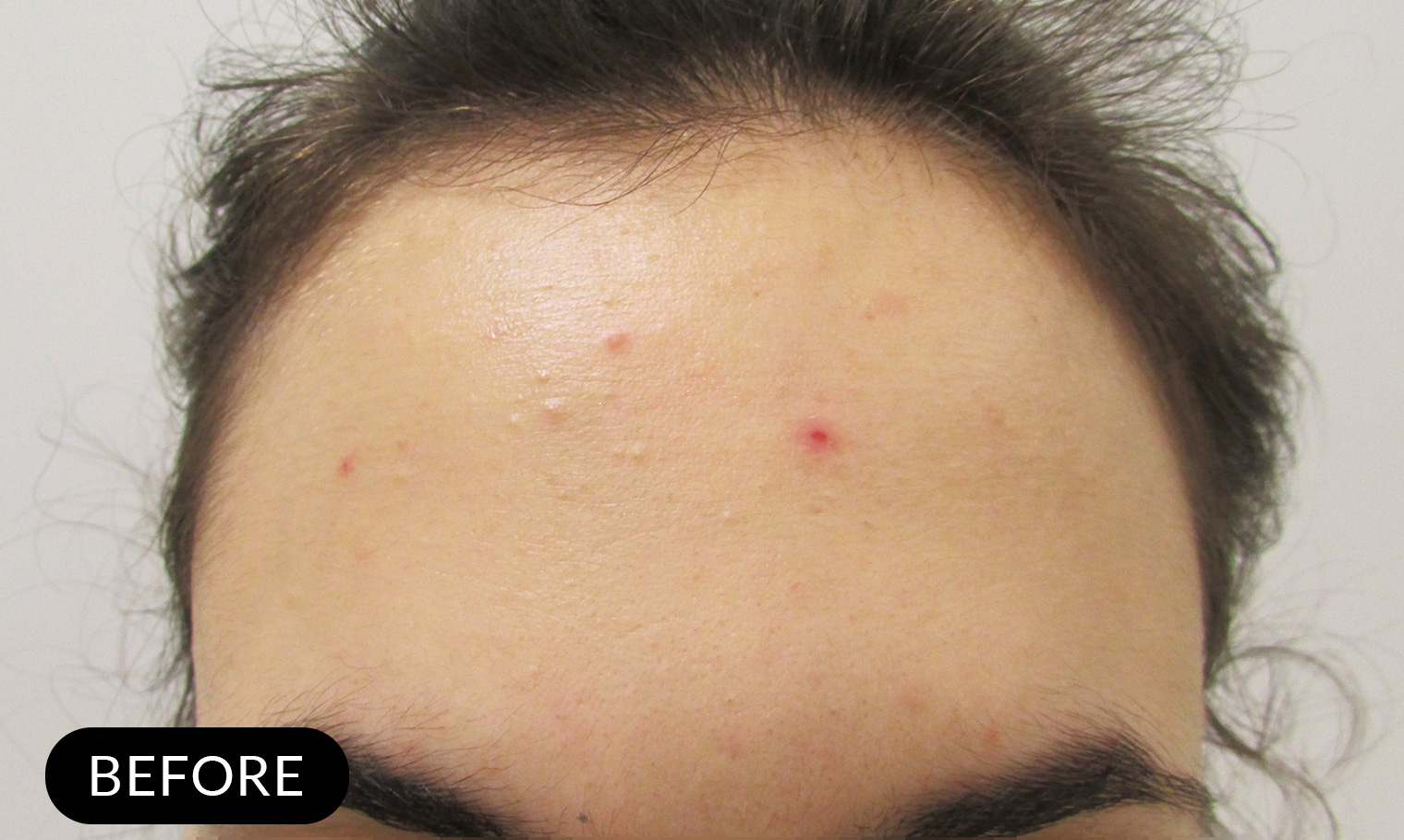 Blemished skin with acne before using Pevonia's ProCorrective Clear-Control solution