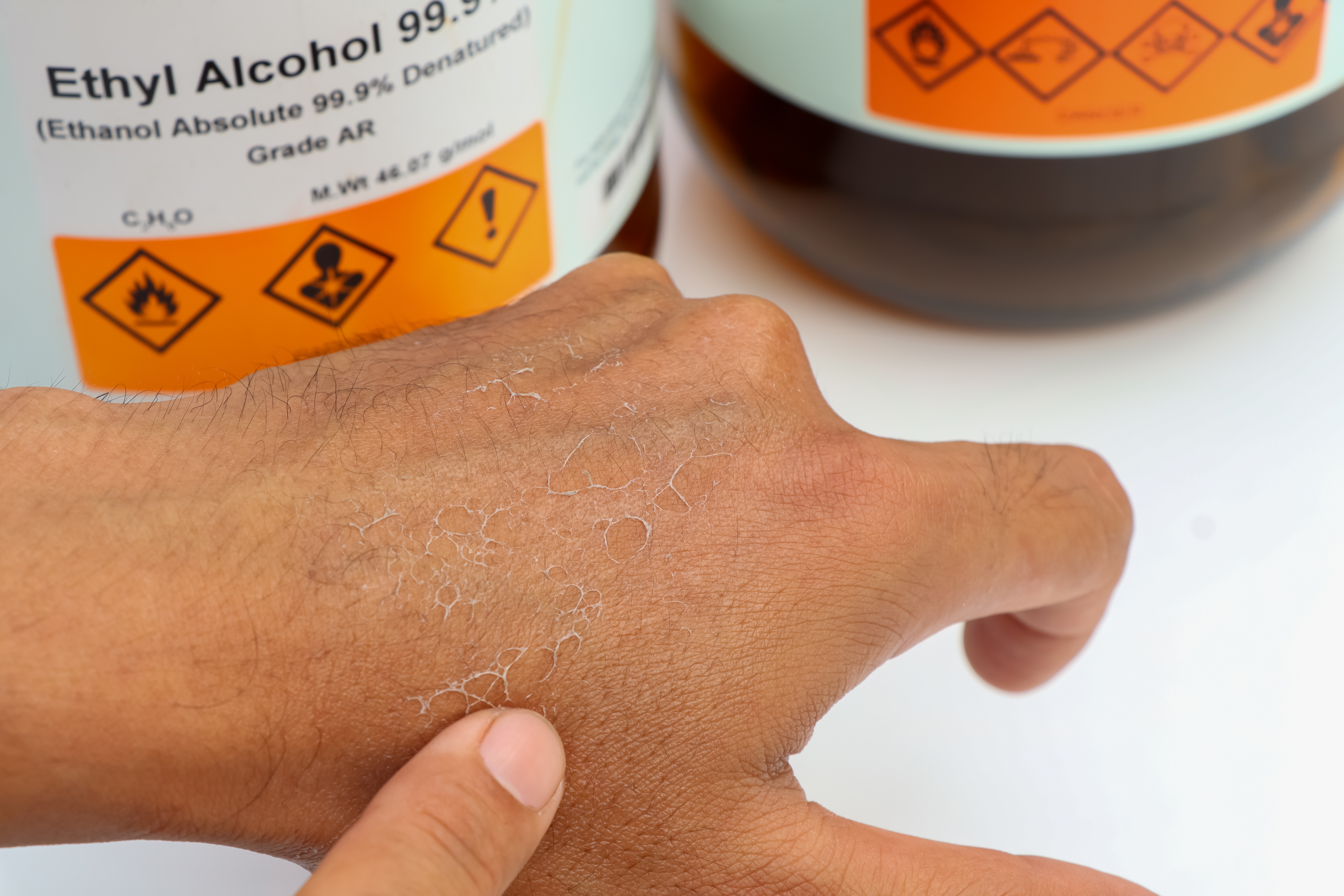 Image of a hand with corrosive skin damage