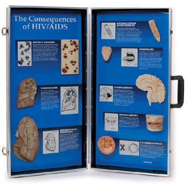 Consequences of HIV/AIDS 3D Display