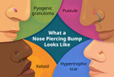 "What Do Piercing Bumps Look Like and When Should You See a Doctor?" "What Do Piercing Bumps Look Like and When Should You See a Doctor?"