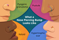 "What Do Piercing Bumps Look Like and When Should You See a Doctor?"