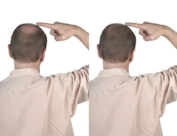 ¿Cuál es la mejor solución para la caída del cabello?