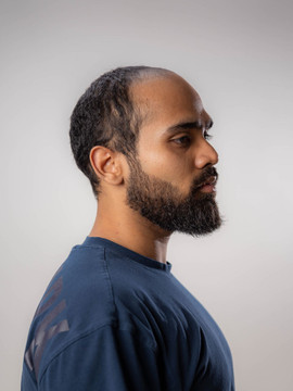 Pótesis capilar M158M de tul francés y poli rizada con cabello Remy indio suave de alta densidadr - antes