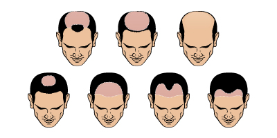 Cómo elegir la Prótesis capilar perfecta para tu patrón de caída del cabello