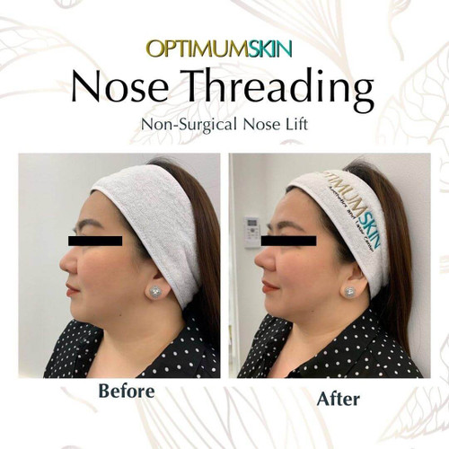 Nose Threadlift