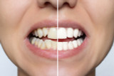 Snap-on Veneers vs. Permanent Veneers 