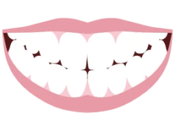 Mouth showing top and bottom veneers
