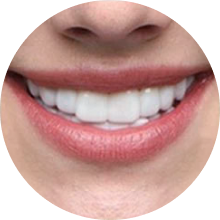 Fair skin veneer user smiling