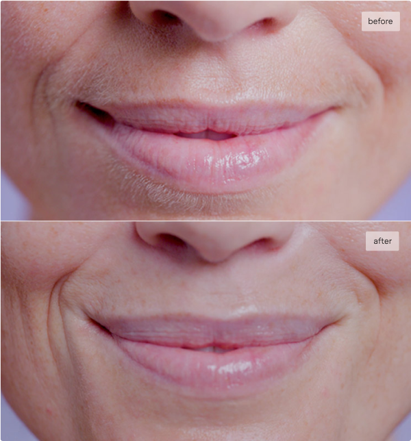 Before and After Lystra