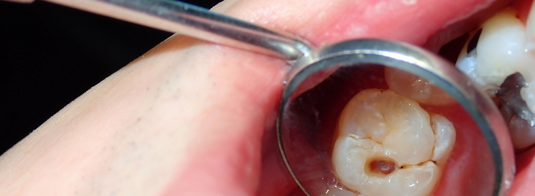 How Long Does it Take a Cavity to Form?