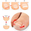 4/10Sheets Nail Correction Stickers Ingrown Toenail Corrector Patches Paronychia Treatment Recover Corrector Pedicure Tools