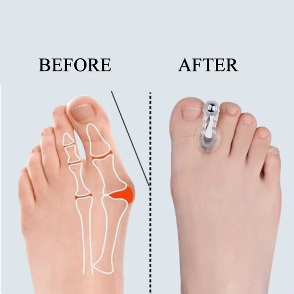 2pcs Bunion Hallux Valgus Corrector Toe Spreader Separator Thumb Finger Correction Straightener Foot Care Tool