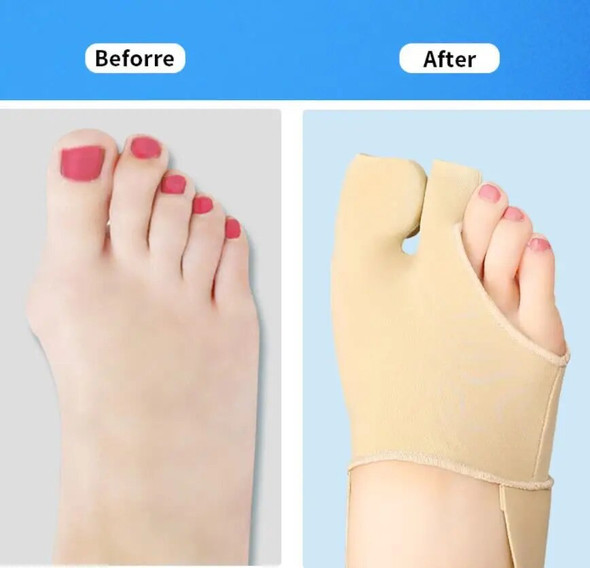 100 pairs Bunion Corrector Toe Straightener Built-in Big Gel Separator Pad Hallux Valgus Protector Sleeve Orthopedic supplies