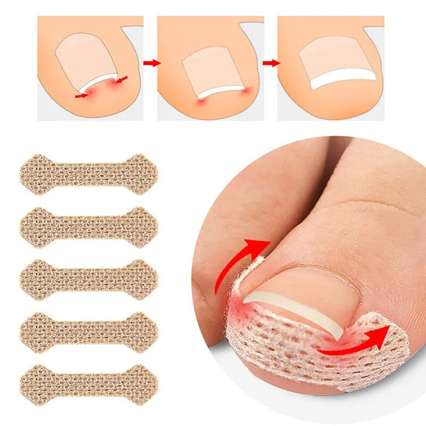 4/10Sheets Nail Correction Stickers Ingrown Toenail Corrector Patches Paronychia Treatment Recover Corrector Pedicure Tools