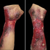 Techline Severe Burn Right Forearm