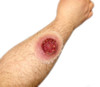 Techline Trauma Gunshot Exit Wound - Large