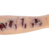 TOMManikin Shrapnel Injury Right Arm