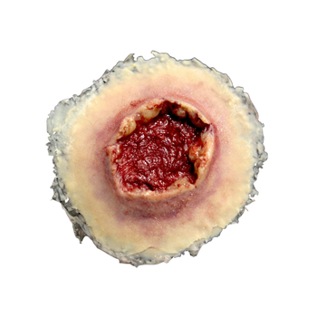 Techline Trauma Gunshot Exit Wound - Large