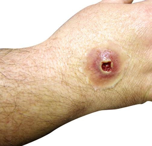 Techline Trauma Gunshot Entry Wound - Small