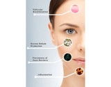 The Four Main Causes of Acne