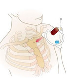 FAST1™ Intraosseous Infusion System - Rescue Essentials