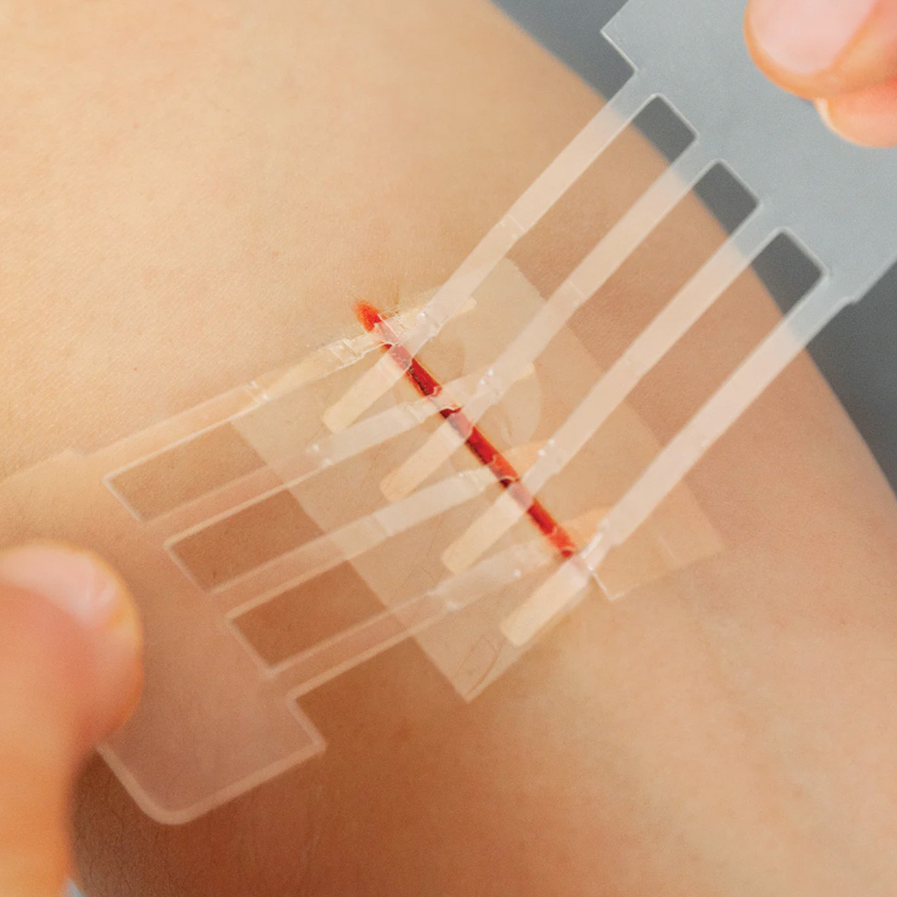 Emergency Laceration Closures, Variety 3 Pack (20/30/40mm or