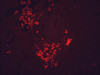 Immunohistochemistry analysis using Mouse Anti-Hsp90 Monoclonal Antibody, Clone H9010 (STMA00005). Tissue: colon carcinoma. Species: Human. Fixation: Formalin. Primary Antibody: Mouse Anti-Hsp90 Monoclonal Antibody (STMA00005) at 1:10000 for 12 hours at 4°C. Secondary Antibody: Alexa Fluor 555 Goat Anti-Mouse (red) at 1:5000 for 1 hour at RT. Magnification: 40x. This image was produced using an amplifying IHC wash buffer.