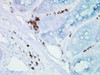 Immunohistochemistry analysis using Mouse Anti-Hsp70 Monoclonal Antibody, Clone BB70 (STMA00004). Tissue: inflamed colon. Species: Mouse. Fixation: Formalin. Primary Antibody: Mouse Anti-Hsp70 Monoclonal Antibody (STMA00004) at 1:10000 for 12 hours at 4°C. Secondary Antibody: Biotin Goat Anti-Mouse at 1:2000 for 1 hour at RT. Counterstain: Mayer Hematoxylin (purple/blue) nuclear stain at 200 µl for 2 minutes at RT.