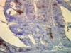 Immunohistochemistry analysis using Mouse Anti-Hsp70 Monoclonal Antibody, Clone BB70 (STMA00004). Tissue: colon carcinoma. Species: Human. Fixation: Formalin. Primary Antibody: Mouse Anti-Hsp70 Monoclonal Antibody (STMA00004) at 1:10000 for 12 hours at 4°C. Secondary Antibody: Biotin Goat Anti-Mouse at 1:2000 for 1 hour at RT. Counterstain: Mayer Hematoxylin (purple/blue) nuclear stain at 200 µl for 2 minutes at RT.