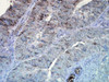 Immunohistochemistry analysis using Mouse Anti-Hsp90 Monoclonal Antibody, Clone D7alpha (STMA00020). Tissue: colon carcinoma. Species: Human. Fixation: Formalin. Primary Antibody: Mouse Anti-Hsp90 Monoclonal Antibody (STMA00020) at 1:100000 for 12 hours at 4°C. Secondary Antibody: Biotin Goat Anti-Mouse at 1:2000 for 1 hour at RT. Counterstain: Mayer Hematoxylin (purple/blue) nuclear stain at 200 µl for 2 minutes at RT. Magnification: 40x.