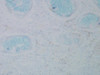 Immunohistochemistry analysis using Mouse Anti-Nitrotyrosine Monoclonal Antibody, Clone 39B6 (STMA00033). Tissue: colon carcinoma. Species: Human. Fixation: Formalin. Primary Antibody: Mouse Anti-Nitrotyrosine Monoclonal Antibody (STMA00033) at 1:25000 for 12 hours at 4°C. Secondary Antibody: Biotin Goat Anti-Mouse at 1:2000 for 1 hour at RT. Counterstain: Mayer Hematoxylin (purple/blue) nuclear stain at 200 µl for 2 minutes at RT.