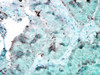 Immunohistochemistry analysis using Mouse Anti-Hsp90 Monoclonal Antibody, Clone 4F3.E8 (STMA00028). Tissue: colon carcinoma. Species: Human. Fixation: Formalin. Primary Antibody: Mouse Anti-Hsp90 Monoclonal Antibody (STMA00028) at 1:100000 for 12 hours at 4°C. Secondary Antibody: Biotin Goat Anti-Mouse at 1:2000 for 1 hour at RT. Counterstain: Mayer Hematoxylin (purple/blue) nuclear stain at 200 µl for 2 minutes at RT.