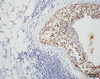 Immunohistochemistry analysis using Rat Anti-HSF1 Monoclonal Antibody, Clone 4B4 (STMA00163). Tissue: Breast carcinoma. Species: Human. Fixation: 10% Formalin Solution for 20 hours at RT. Primary Antibody: Rat Anti-HSF1 Monoclonal Antibody (STMA00163) at 1:2000 for 40 min. Secondary Antibody: Dako labeled Polymer HRP Anti-rat IgG, DAB Chromogen (brown) (Dako Envision+ System) for 30 min at RT.