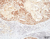Immunohistochemistry analysis using Rat Anti-HSF1 Monoclonal Antibody, Clone 10H4 (STMA00162). Tissue: Breast carcinoma. Species: Human. Fixation: 10% Formalin Solution for 20 hours at RT. Primary Antibody: Rat Anti-HSF1 Monoclonal Antibody (STMA00162) at 1:8000 for 40 min. Secondary Antibody: Dako labeled Polymer HRP Anti-rat IgG, DAB Chromogen (brown) (Dako Envision+ System) for 30 min at RT.