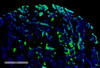Immunohistochemistry analysis using Rabbit Anti-Thymidine Glycol Monoclonal Antibody, Clone B29 (STMA00217). Tissue: renal cancer. Species: Human. Primary Antibody: Rabbit Anti-Thymidine Glycol Monoclonal Antibody (STMA00217) at 1:100 for Overnight at 4C, then 30 min at 37C. Secondary Antibody: Goat Anti-Mouse IgG (H+L): FITC for 45 min at 37C. Counterstain: DAPI for 3 min at RT.