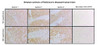 Immunohistochemistry analysis with Mouse Anti-Human Alpha Synuclein N-Terminal Monoclonal Antibody, Clone 11D4 (STMA00225). Tissue: Striatum sections of Parkinson’s Diseased Brain. Species: Human. Fixation: Paraffin embedded, 5um thin. Blocking: 3% milk for 1 hour at RT. Antigen Retrieval: Citrate buffer, pH 6.0, boiled for 20 min. Primary Antibody: Mouse Anti-Human Alpha Synuclein N-Terminal Monoclonal Antibody, Clone 11D4 (STMA00225).