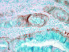 Immunohistochemistry analysis using Rabbit Anti-HSP70 Polyclonal Antibody (STPA00002). Tissue: colon carcinoma. Species: Human. Fixation: Formalin. Primary Antibody: Rabbit Anti-HSP70 Polyclonal Antibody (STPA00002) at 1:50000 for 12 hours at 4°C. Secondary Antibody: Biotin Goat Anti-Rabbit at 1:2000 for 1 hour at RT. Counterstain: Methyl Green at 200uL for 2 min at RT.
