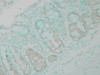 Immunohistochemistry analysis using Rabbit Anti-Ubiquitin Polyclonal Antibody (STPA00015). Tissue: colon carcinoma. Species: Human. Fixation: Formalin. Primary Antibody: Rabbit Anti-Ubiquitin Polyclonal Antibody (STPA00015) at 1:100000 for 12 hours at 4°C. Secondary Antibody: Biotin Goat Anti-Rabbit at 1:2000 for 1 hour at RT. Counterstain: Methyl Green at 200uL for 2 min at RT. This image was produced using an amplifying IHC wash buffer.