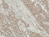 Immunohistochemistry analysis using Rabbit Anti-IGF-1 Polyclonal Antibody (STPA00070). Tissue: Liver. Species: Human. Fixation: Formalin Fixed Paraffin-Embedded. Primary Antibody: Rabbit Anti-IGF-1 Polyclonal Antibody (STPA00070) at 1:50 for 30 min at RT. Counterstain: Hematoxylin. Magnification: 10X. HRP-DAB Detection.