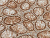 Immunohistochemistry analysis using Rabbit Anti-HSP70 (Acetyl Lys77) Polyclonal Antibody (STPA00079). Tissue: Colon Cancer. Species: Human. Fixation: Formalin Fixed Paraffin-Embedded. Primary Antibody: Rabbit Anti-HSP70 (Acetyl Lys77) Polyclonal Antibody (STPA00079) at 1:50 for 30 min at RT. Counterstain: Hematoxylin. Magnification: 20X. HRP-DAB Detection.