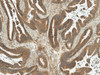 Immunohistochemistry analysis using Rabbit Anti-MDM2 Polyclonal Antibody (STPA00083). Tissue: Stomach Cancer. Species: Human. Fixation: Formalin Fixed Paraffin-Embedded. Primary Antibody: Rabbit Anti-MDM2 Polyclonal Antibody (STPA00083) at 1:50 for 30 min at RT. Counterstain: Hematoxylin. Magnification: 10X. HRP-DAB Detection.