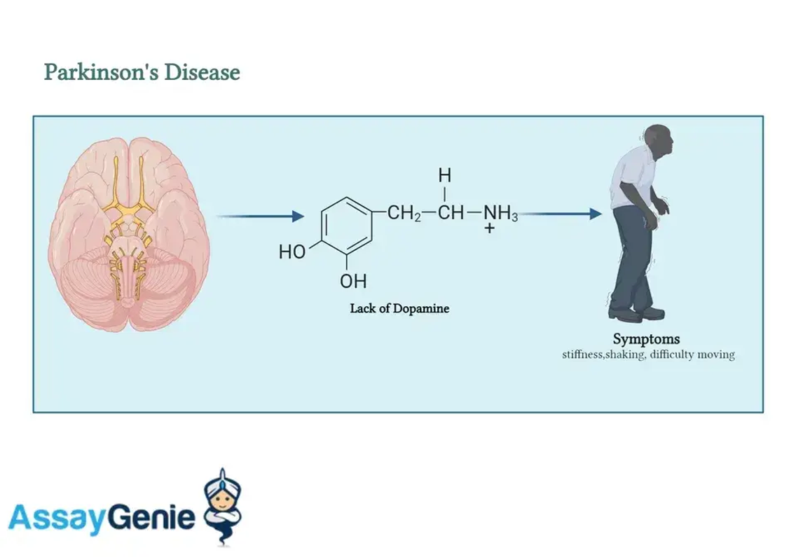 Entschlüsselung der Parkinson-Krankheit: Einblicke in eine komplexe neurologische Störung