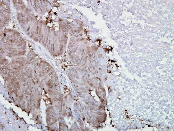 Immunohistochemistry analysis using Mouse Anti-Hsp90 alpha Monoclonal Antibody, Clone K41009 (STMA00006). Tissue: colon carcinoma. Species: Human. Fixation: Formalin. Primary Antibody: Mouse Anti-Hsp90 alpha Monoclonal Antibody (STMA00006) at 1:5000 for 12 hours at 4°C. Secondary Antibody: Biotin Goat Anti-Mouse at 1:2000 for 1 hour at RT. Counterstain: Mayer Hematoxylin (purple/blue) nuclear stain at 200 µl for 2 minutes at RT.